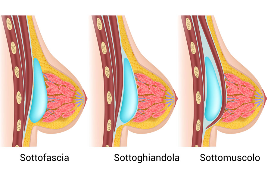Zone di inserimento della protesi seno